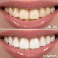 blanqueamiento-dental