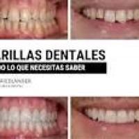 Carillas Dentales Precios Y